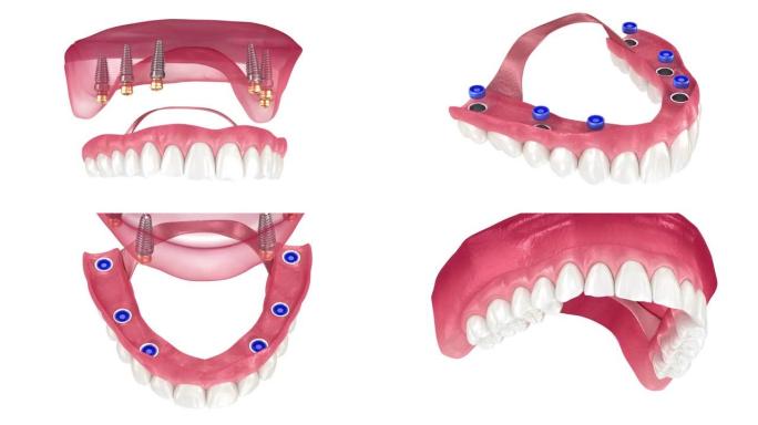 由植入物支持的6系统上的口香糖可移动假体。牙科3D动画