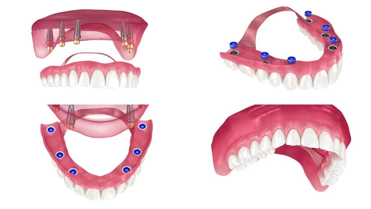 由植入物支持的6系统上的口香糖可移动假体。牙科3D动画