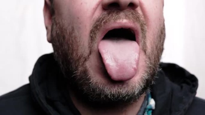 这个人伸出舌头。舌头上的斑块检查。刮胡子的人。