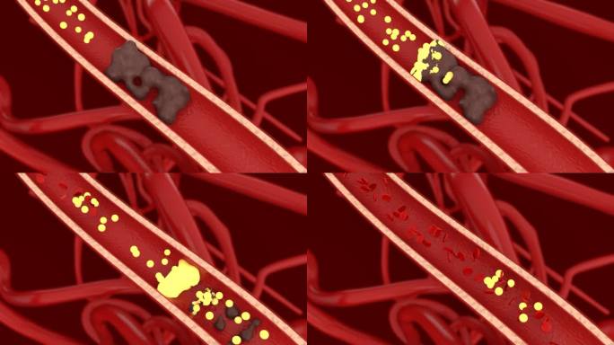 血管堵塞清理血管垃圾视频素材