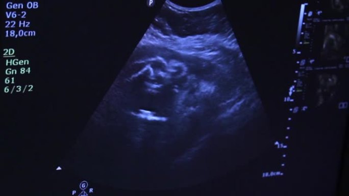 胎儿的头部看到了放射性同位素桌面壁纸