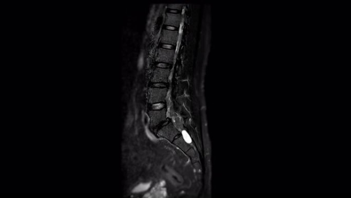 MRI l-s脊柱或腰椎矢状位T2W脂肪抑制诊断脊髓压迫。