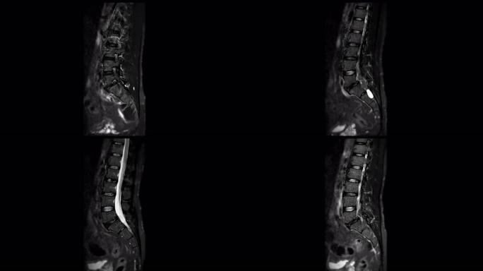 MRI l-s脊柱或腰椎矢状位T2W脂肪抑制诊断脊髓压迫。