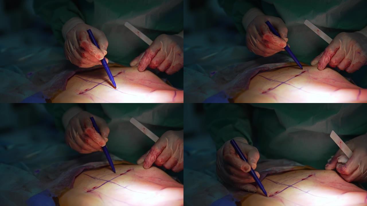 医生用标记在病人的腹部画线条。外科医生在腹部标记问题部位，以便进一步吸脂。特写。