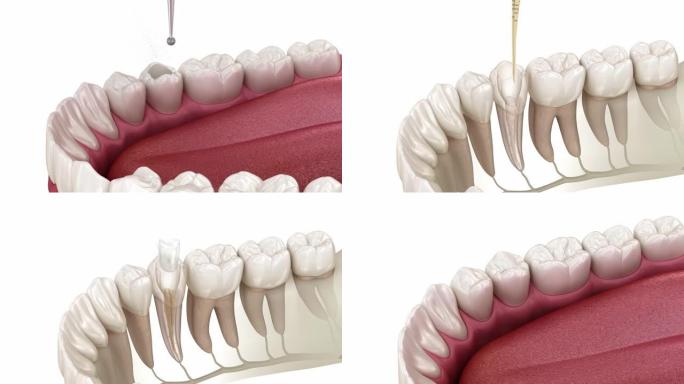 根管治疗过程。医学上精确的牙齿3D动画