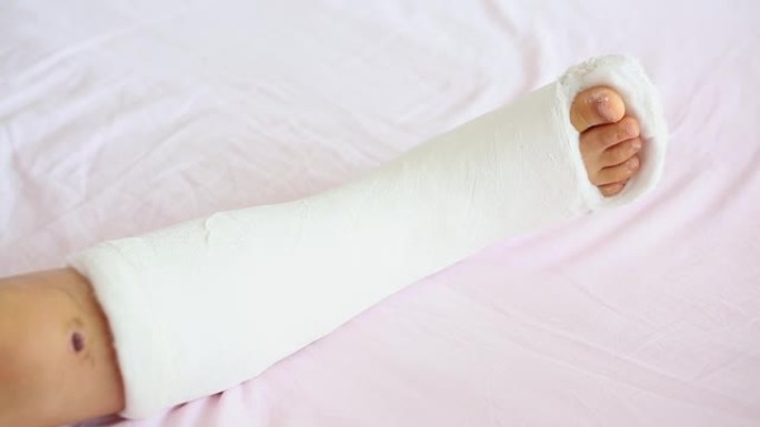 急救后，整形外科的儿童腿在整形外科的白色床上铸造。一个小孩的石膏断腿。
