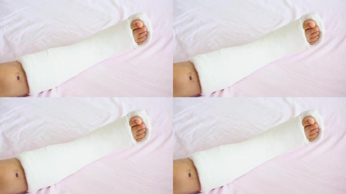 急救后，整形外科的儿童腿在整形外科的白色床上铸造。一个小孩的石膏断腿。