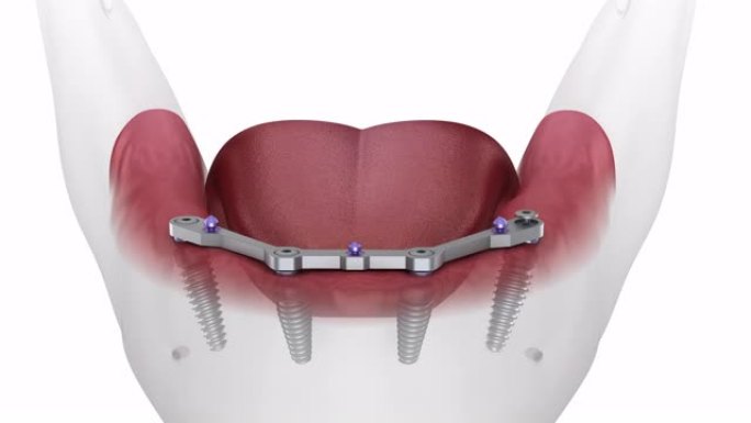 下颌假体与牙龈All on 4系统由植入物支撑。医学上精确的3D动画