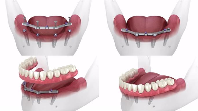 下颌假体与牙龈All on 4系统由植入物支撑。医学上精确的3D动画