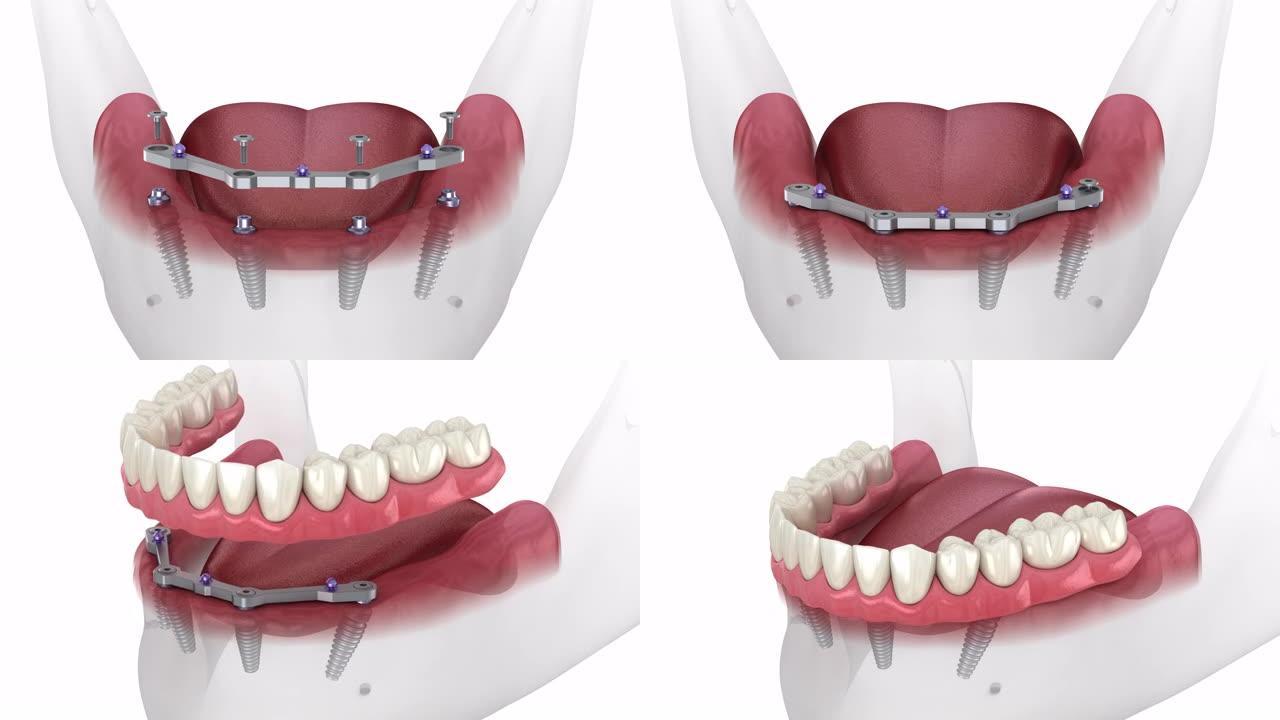 下颌假体与牙龈All on 4系统由植入物支撑。医学上精确的3D动画
