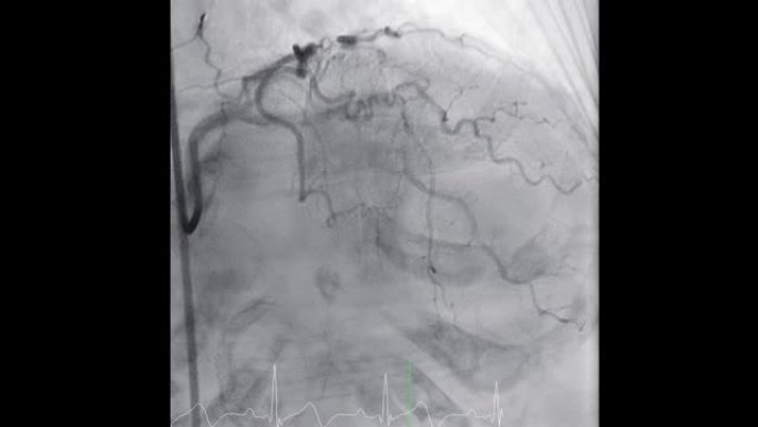 显示冠状动脉的心导管检查以诊断心脏骤停。