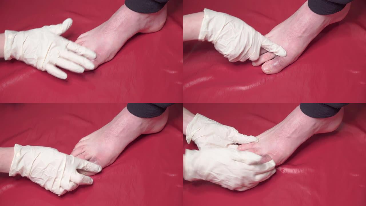 医生戴着手套的手在病人受伤的脚趾上涂上药膏。