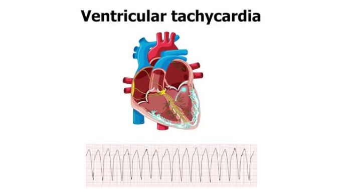 心电图室性心动过速 (VT) 的心脏动画