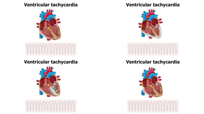 心电图室性心动过速 (VT) 的心脏动画