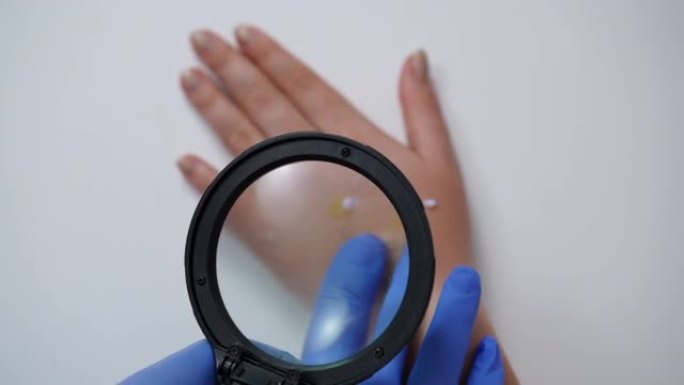 顶视放大镜用医生手戴手套检查雌性手掌上的猴痘疹。无法识别的医生在慢动作特写中分析患有猴痘的白人妇女的
