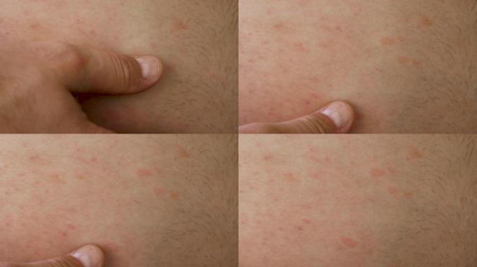皮肤过敏区域。皮肤上的过敏性皮疹特写。人类过敏性疾病。男人皮肤上的红点。中国腹部皮肤病