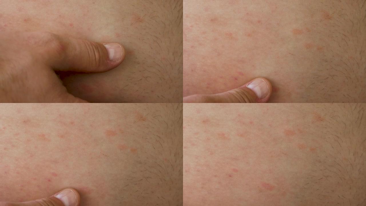 皮肤过敏区域。皮肤上的过敏性皮疹特写。人类过敏性疾病。男人皮肤上的红点。中国腹部皮肤病