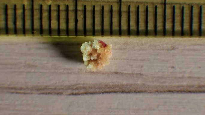 草酸盐肾结石4毫米，将结石从肾脏中取出，特写肾结石。人类肾脏中形成的天然结石
