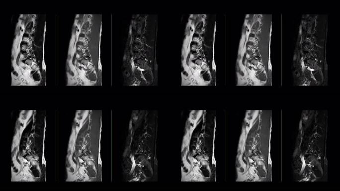 MRI l-s脊柱或腰椎矢状位T2W、T1W和T2W脂肪抑制诊断脊髓压迫。
