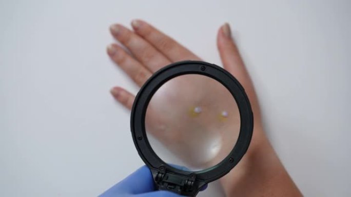用放大镜慢动作分析猴痘皮疹的俯视图。手拿医疗手套检查女性高加索手掌有传染病症状特写。