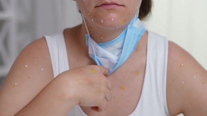 患有皮疹的女人放下面罩显示出猴痘皮炎。年轻面目全非的白人女士，皮肤上有痤疮，坐在室内前视图。