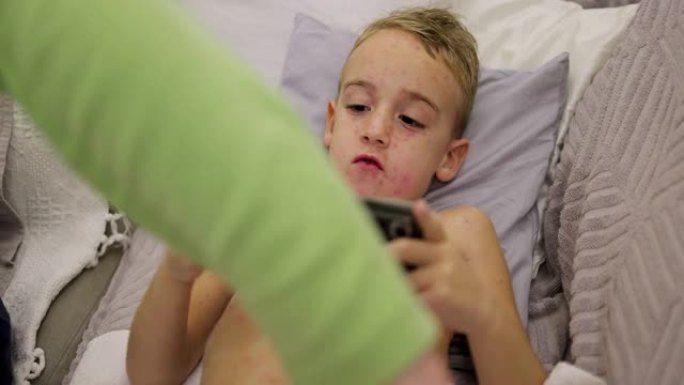母亲在儿子的皮肤上涂上药膏，以减少水痘的瘙痒，而他在手机上玩电子游戏