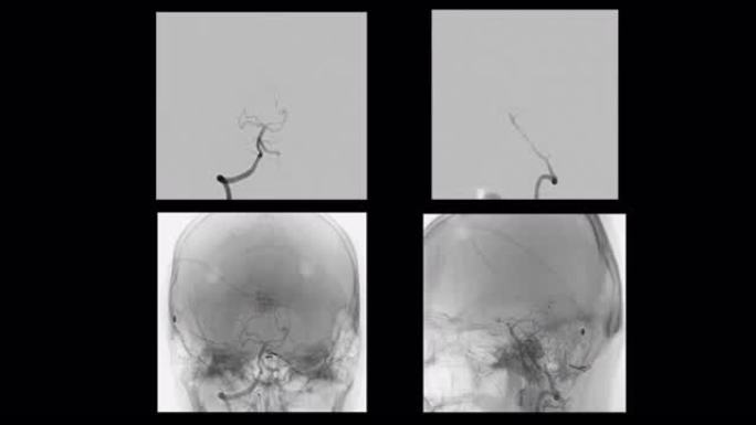 脑血管造影。