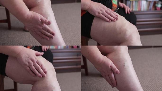成熟的女人用静脉曲张按摩她的腿。