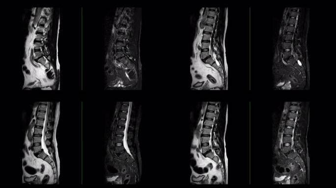 MRI l-s脊柱或腰椎矢状位T2W和T2W脂肪抑制可诊断脊髓压迫。