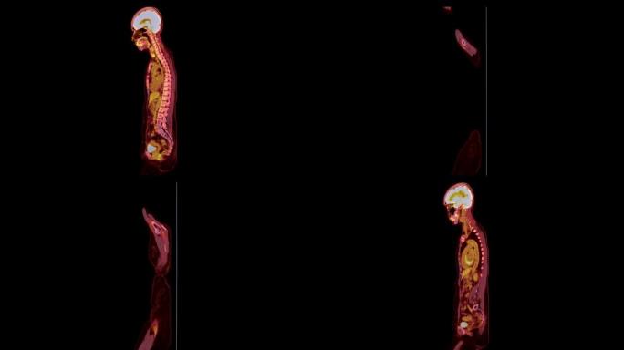 PET ct扫描 (正电子发射断层扫描) 的全身3d渲染图像红色色调轴视图，用于检测肿瘤术后复发。