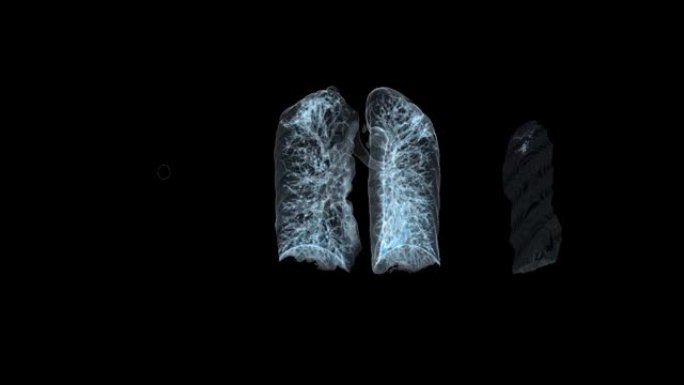 CT胸部或肺部3D渲染用于诊断结核病，结核病和covid-19。
