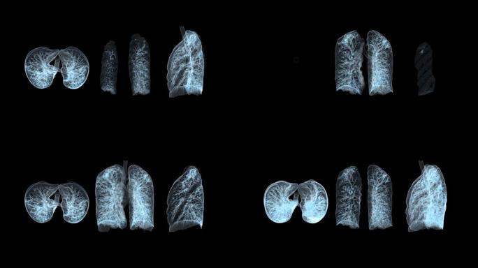 CT胸部或肺部3D渲染用于诊断结核病，结核病和covid-19。