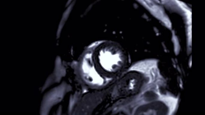 MRI心脏或心脏MRI (磁共振成像) 心脏在短轴视图。