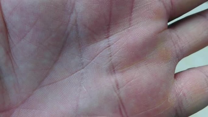 指甲上的皮肤脱皮，维生素c缺乏和指甲皮肤病，