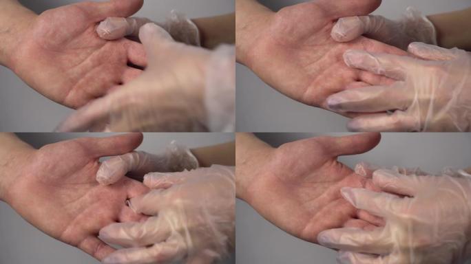 医生检查男人手上的真菌病。手指上的愈伤组织。特写手。4k