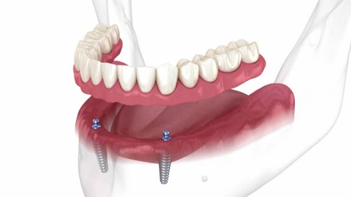 下颌骨可移动假体全部在2系统上由带有球附件的植入物支撑。医学上精确的牙科3D动画