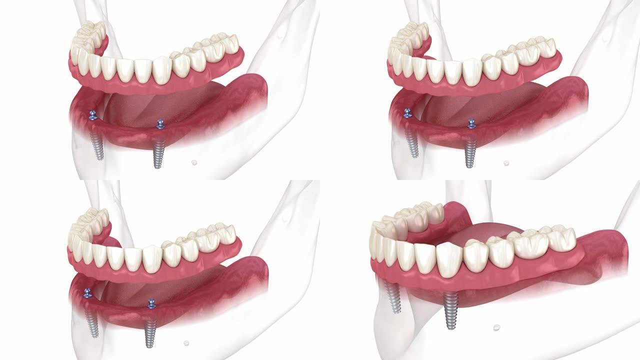 下颌骨可移动假体全部在2系统上由带有球附件的植入物支撑。医学上精确的牙科3D动画