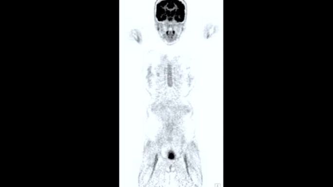 PET ct扫描 (正电子发射断层扫描) 的全身3d渲染图像红色色调轴视图，用于检测肿瘤术后复发。