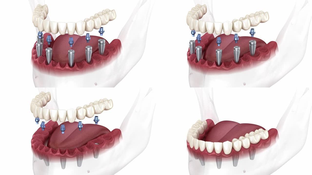 可摘下颌假体全部在6系统上由植入物支撑。人体牙齿和假牙的医学精确3D动画