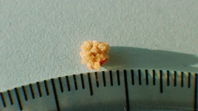 从人体肾脏特写镜头拍摄草酸盐结石，用尺子测量结石的大小。来自人类肾脏4毫米的磷酸盐或尿酸盐结石