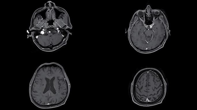 MRI脑轴图。