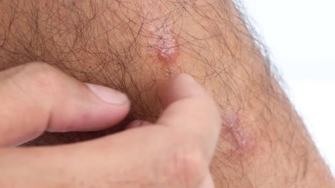 由蚊子擦伤引起的皮肤上的伤口过敏皮肤