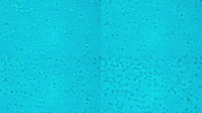 感染流感病毒或冠状病毒的人肺组织的巨噬细胞。实验室显微镜下的肺泡巨噬细胞。免疫系统的细胞