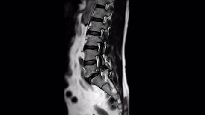MRI l-s脊柱或腰椎矢状位T2W诊断脊髓压迫。