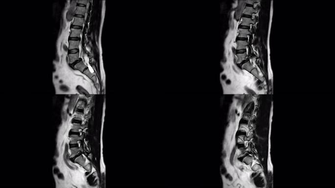 MRI l-s脊柱或腰椎矢状位T2W诊断脊髓压迫。