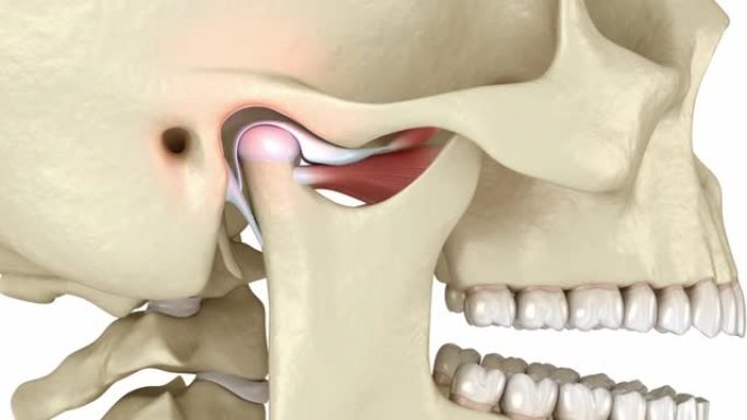 颞下颌关节和脱位关节盘。医学上精确的3D动画
