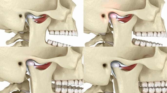 颞下颌关节和脱位关节盘。医学上精确的3D动画
