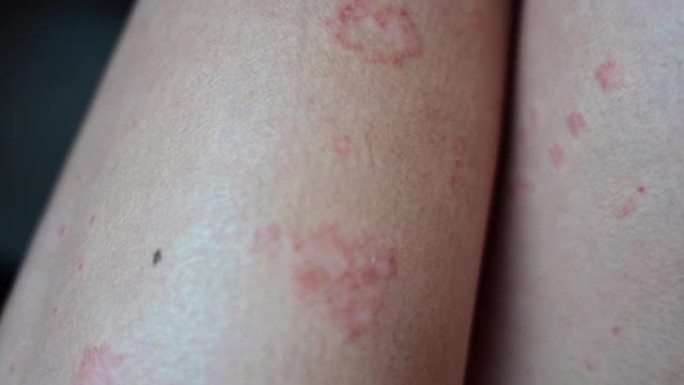亚洲腿部和手臂的特应性皮炎皮肤问题