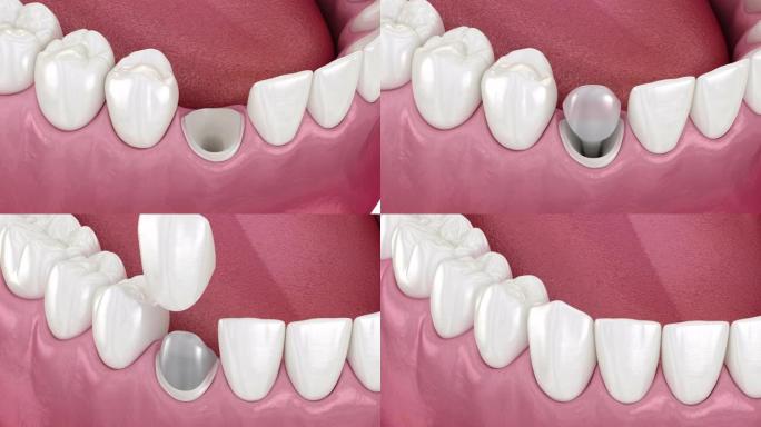 迦南牙齿上的牙残端别针标签。医学上精确的牙科3D动画