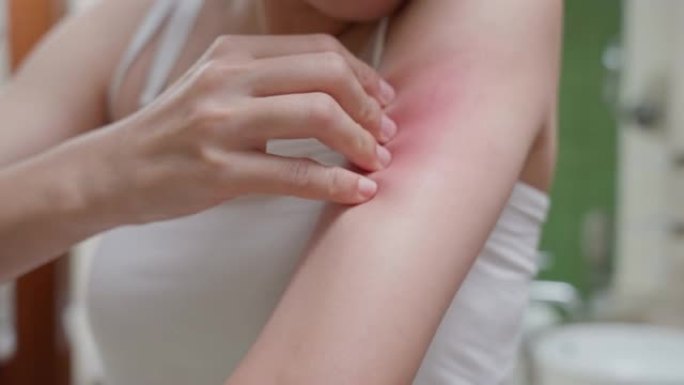 皮肤问题和美容。年轻女子抓伤身体有皮肤发痒过敏，类固醇过敏，敏感皮肤，晒红，化学过敏，皮疹，昆虫叮咬